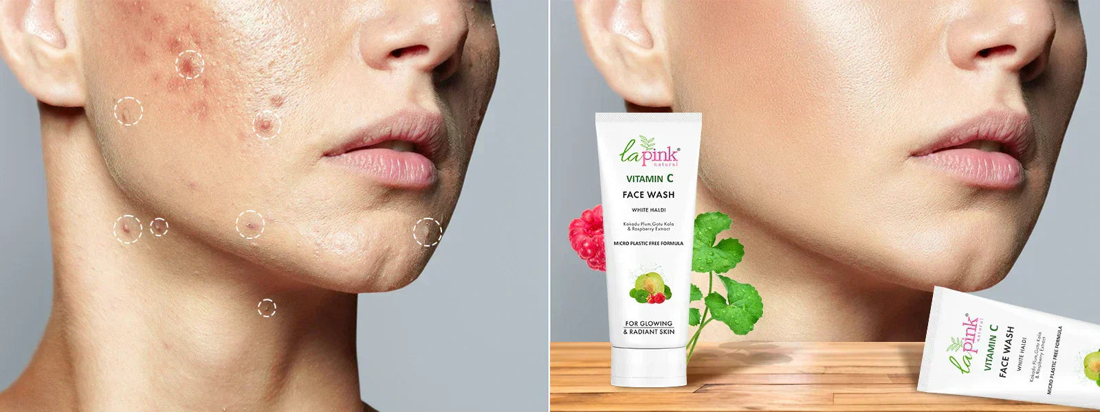 vitaminc to combat acne banner