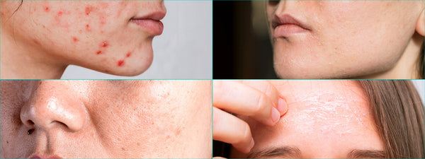 चेहरे के लिए बेस्ट क्रीम: स्किन प्रॉब्लम्स को दूर करने का आसान समाधान