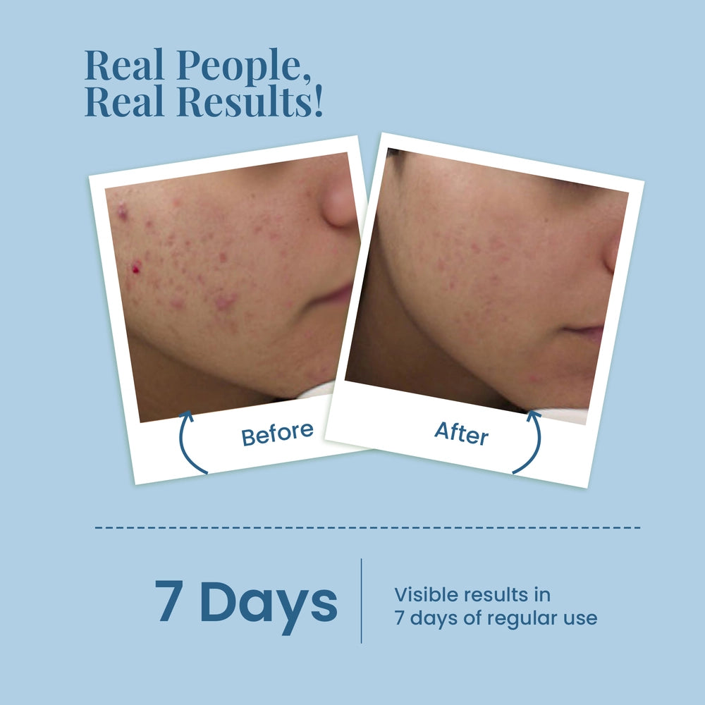 Ultimate Solution for Clear, Poreless Skin - La Pink Acne &amp; Pore Face Wash