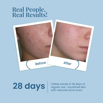 Get Acne-Free Skin in 28 Days with La Pink Acne &amp; Pore Serum